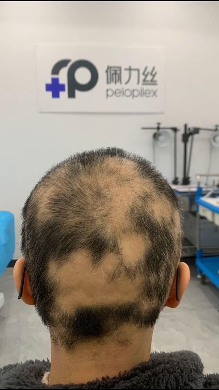 雄脱诊所弥散型斑秃治疗