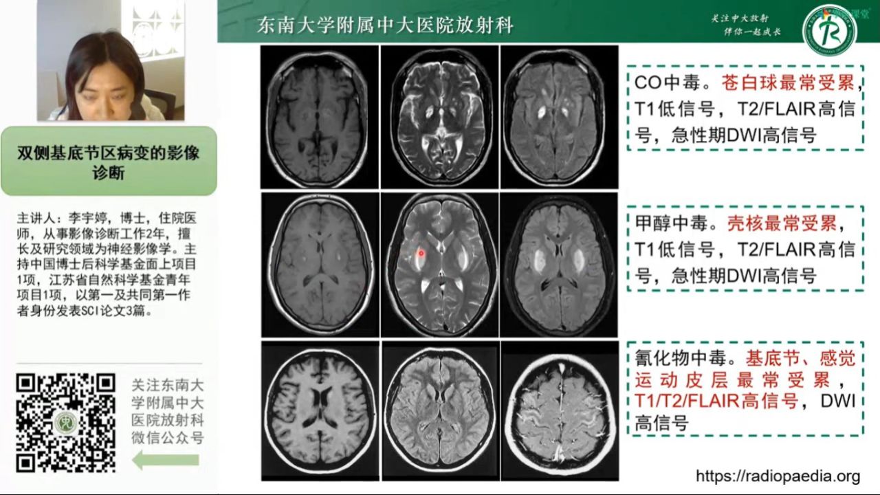 基底节区mri图片