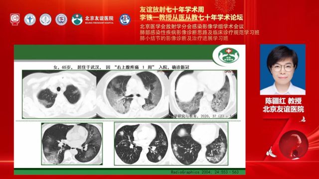 社区获得性肺炎的影像诊断首都医科大学附属北京友谊医院陈疆红