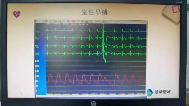 胡福莉医生:心脏早搏为什会感觉“漏跳、乏力”?