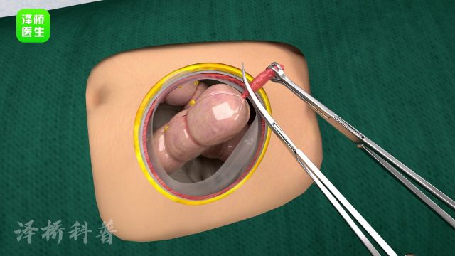 一探究竟!阑尾切除术的3D解剖世界!