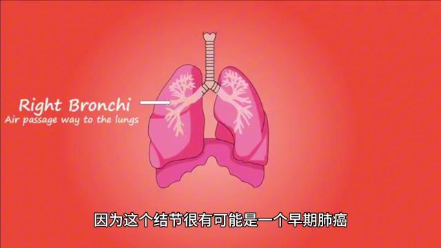 刘懿博士说肺癌(七五一八)不到五毫米肺磨玻璃结节会发展成癌么