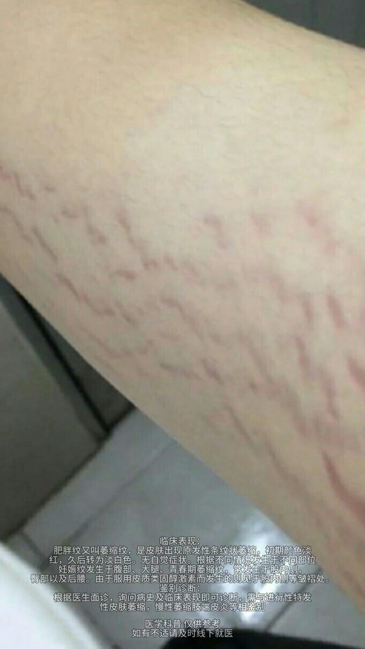 泉州中科皮肤科专家庄永灿揭秘:告别肥胖纹,重塑光滑美肌!