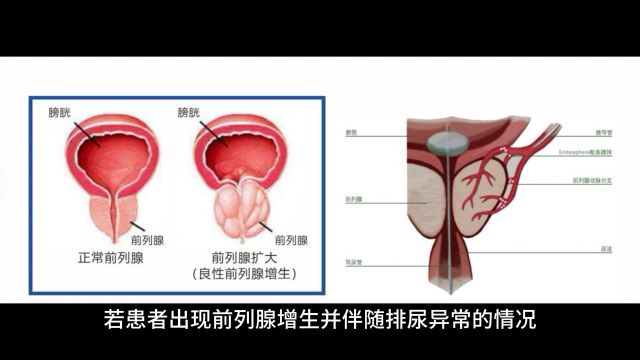 前列腺增生是什么原因引起的