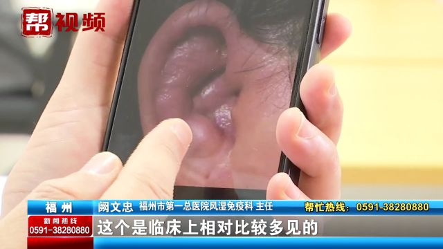 女子两耳肿成花菜样 一查竟是患上罕见病 医生:这类人群应警惕