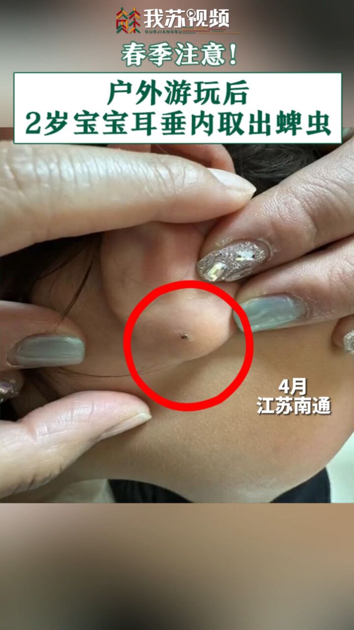春季注意!户外玩耍蜱虫钻进2岁宝宝耳垂