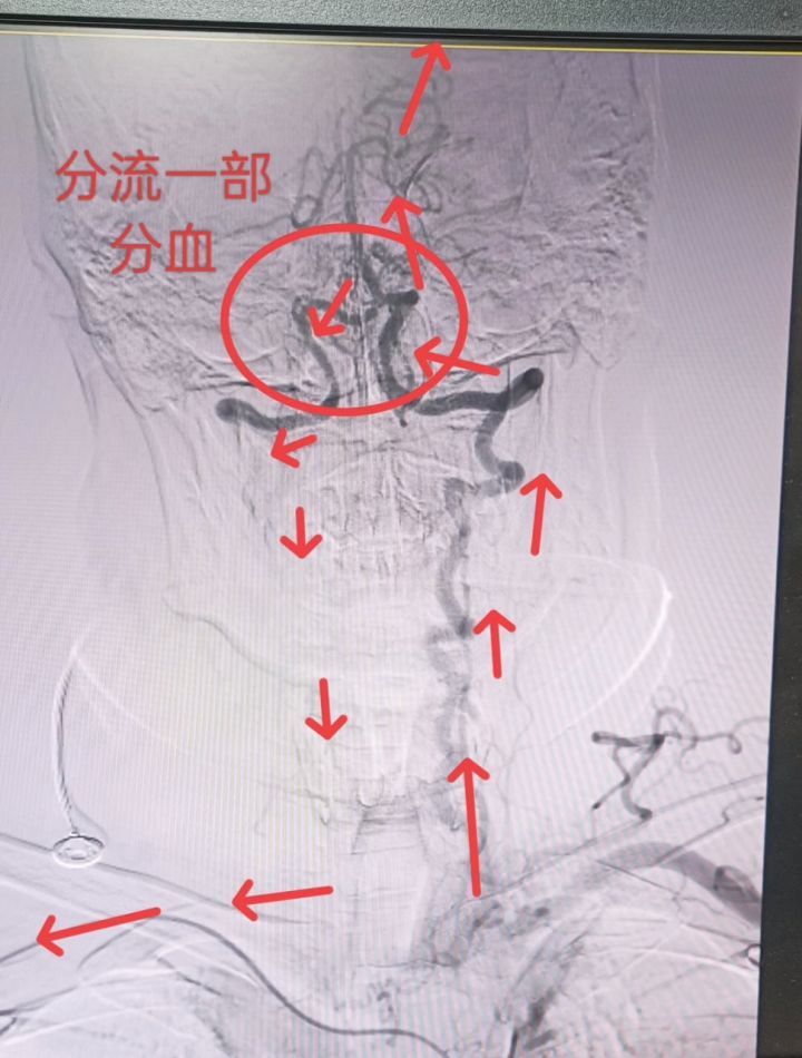 突发晕倒可能是它惹的祸,锁骨下动脉盗血