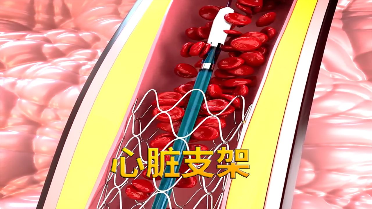 心脏支架的安装全过程,科普动画《心脏支架》