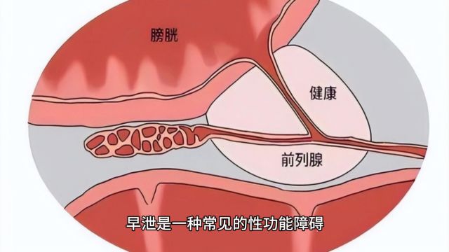 摆脱早泄男性健康张广生