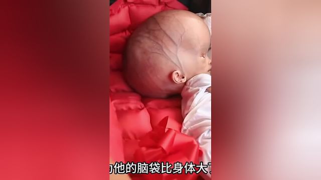 孩子成了头婴童,他究竟怎么了?