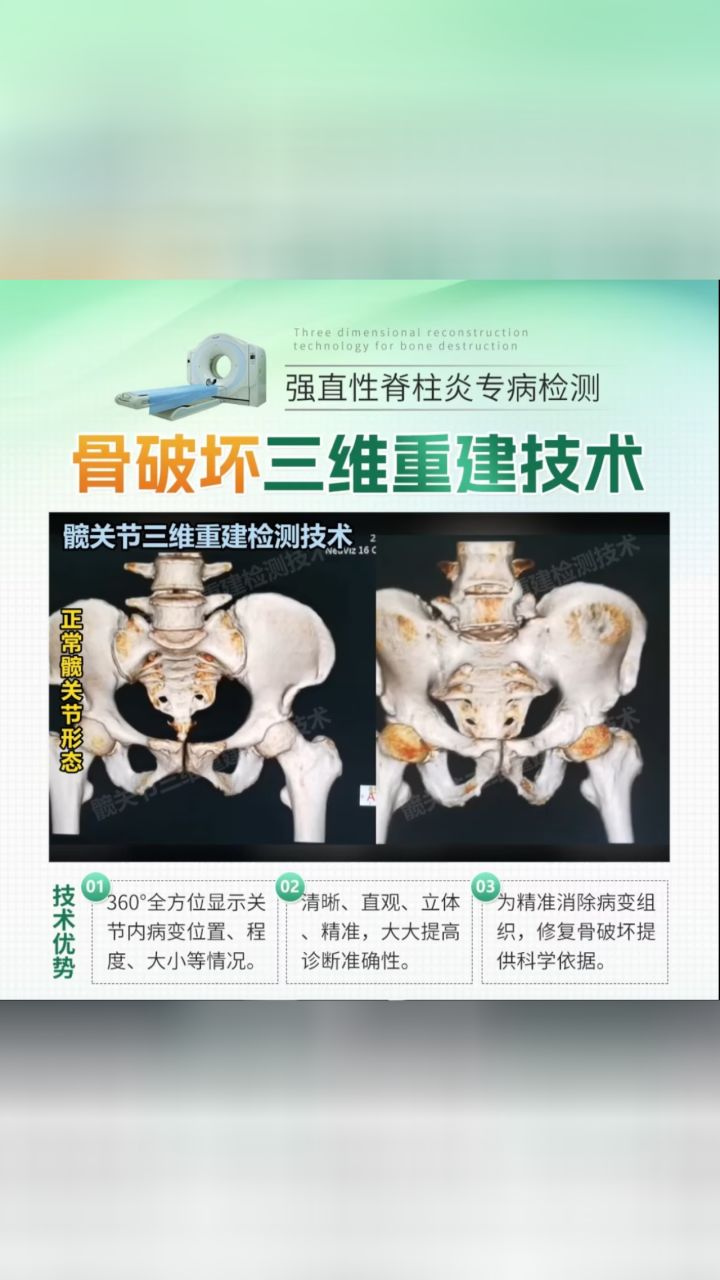 成都附大强直医院强直性脊柱炎专病检测骨破坏三维重建技术