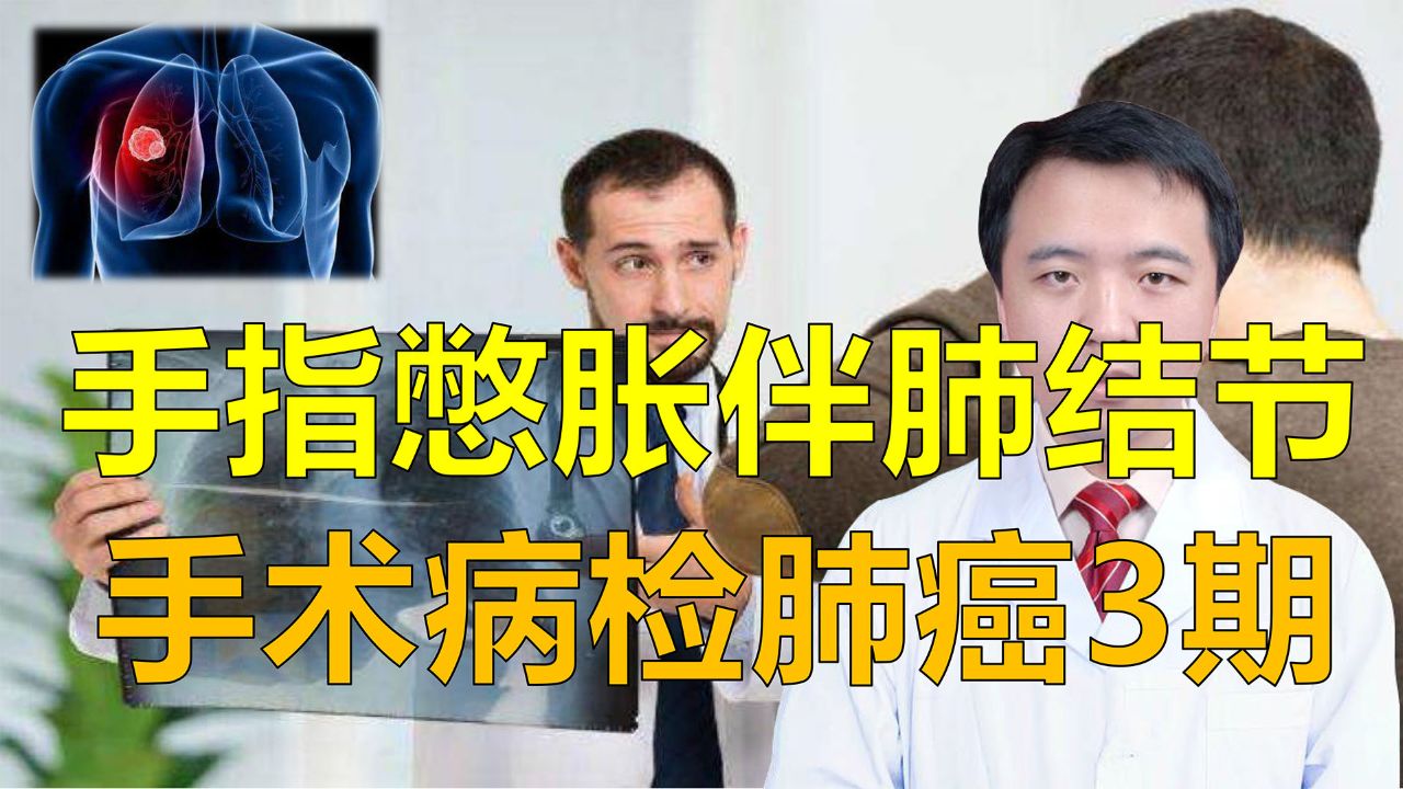 手指憋胀，CT显示肺结节，病检3A期肺癌，需术后辅助治疗_腾讯视频