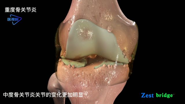 膝关节骨关节炎的形成过程 ——【医学3D动画演示】