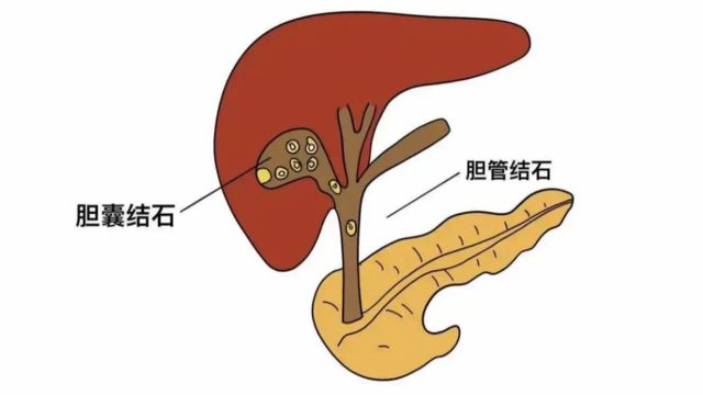 胆石症手术后,有哪些并发症?医生:4个“潜在危险”提前了解