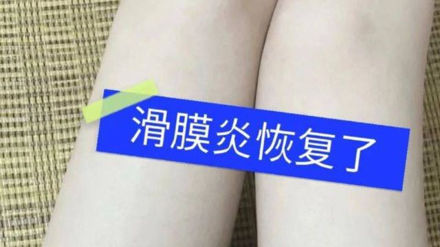 滑膜炎治疗方法大公开!4招解决疼痛,不走弯路还能省钱!