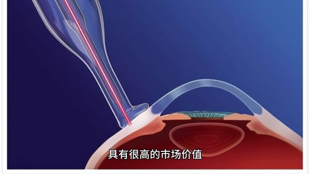 介入消融导管种类与回收价值