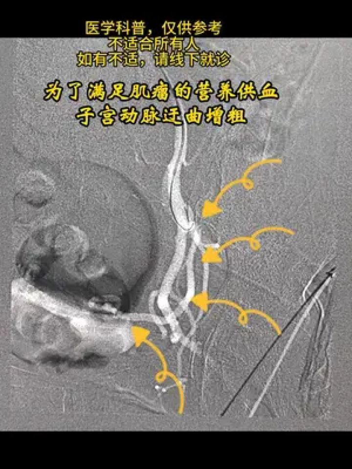 子宫肌瘤,月经过多 #子宫肌瘤 #月经过多 #介入微创 #微创手术 #开工