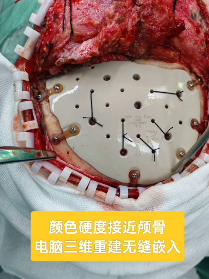peek材料是一种非常好的颅骨修补材料,它的各项性能,包括坚硬度,隔热