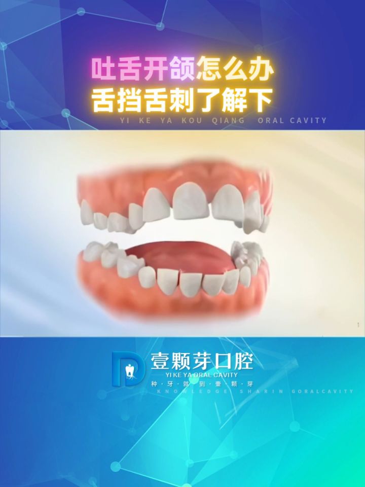 孩子吐舌头的时候,总是牙齿开颌怎么办 试试舌挡舌刺纠正吧🏥#舌挡舌刺#口腔科普@烟台壹颗芽口腔_高清1080P在线观看平台_腾讯视频