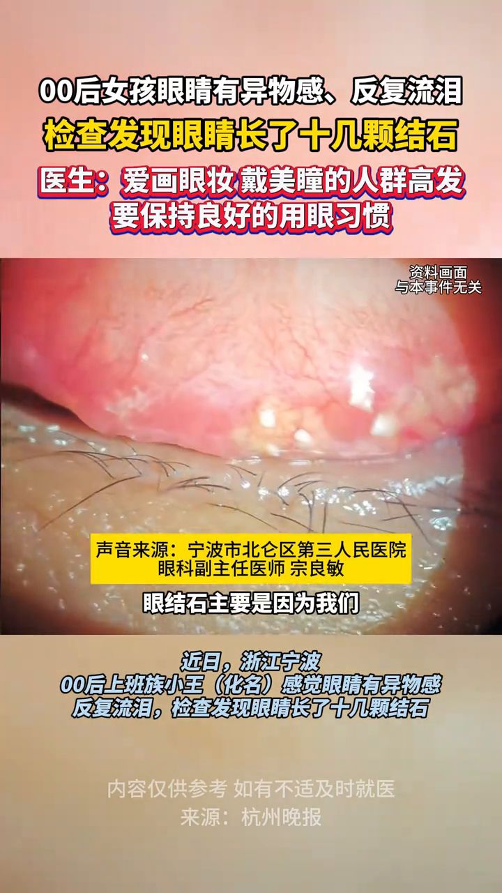 00后女孩眼睛有异物感,反复流泪,检查发现眼睛长了结石