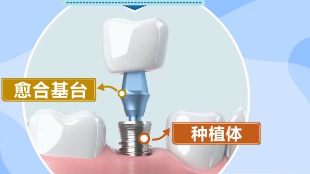 口腔种植体集采落地近一年,到底什么是“种植牙”?