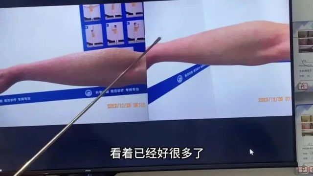 宁波治疗银屑病哪家好?从红皮型银屑病到基本恢复只用了三个多月,他的笑容就是对我院诊疗水平的高度认可!