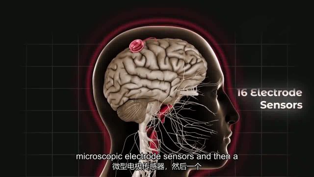 Neuralink开始首次人体实验!字幕