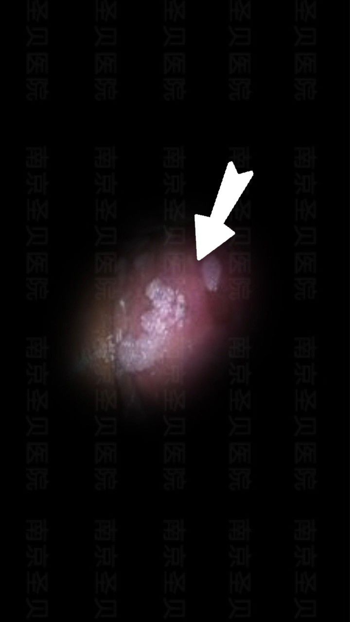 患了尖锐湿怎么治疗