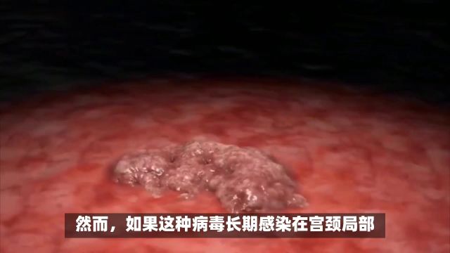 首选东莞莞医医院东莞hpv66阳性严不严重