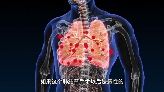 刘懿博士说肺癌(七五九六)肺结节术后没有出病理会影响结账么?