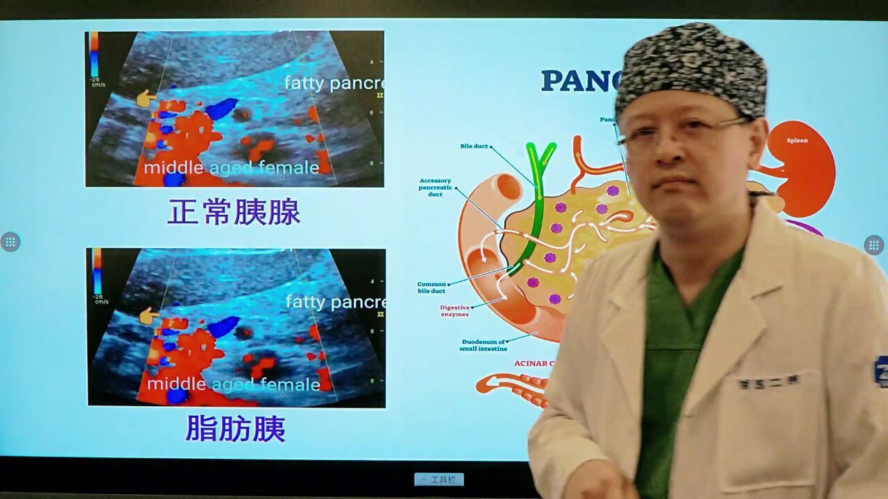 《胰腺脂肪浸润的奥秘》警惕脂肪胰:胰腺癌风险#肝胆胰外科严盛_高清1080P在线观看平台_腾讯视频