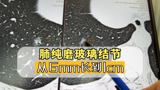 这个肺纯磨玻璃结节,从6mm长到1cm!手术效果依旧好吗?