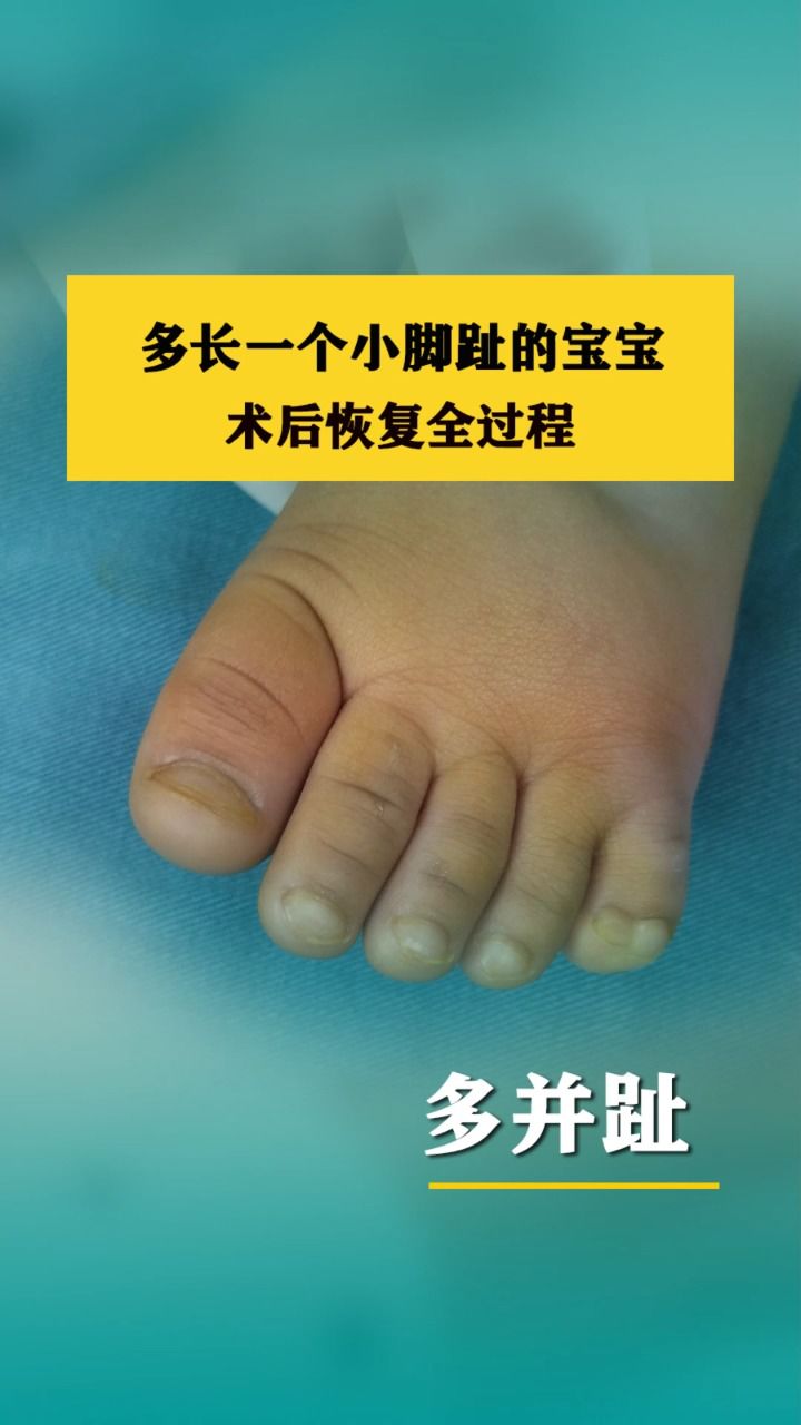 多长一个小脚趾的宝宝,术后恢复全过程