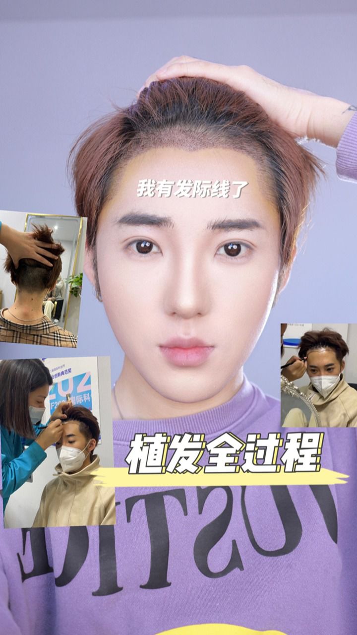 植发男人(男人植发需要多少钱)