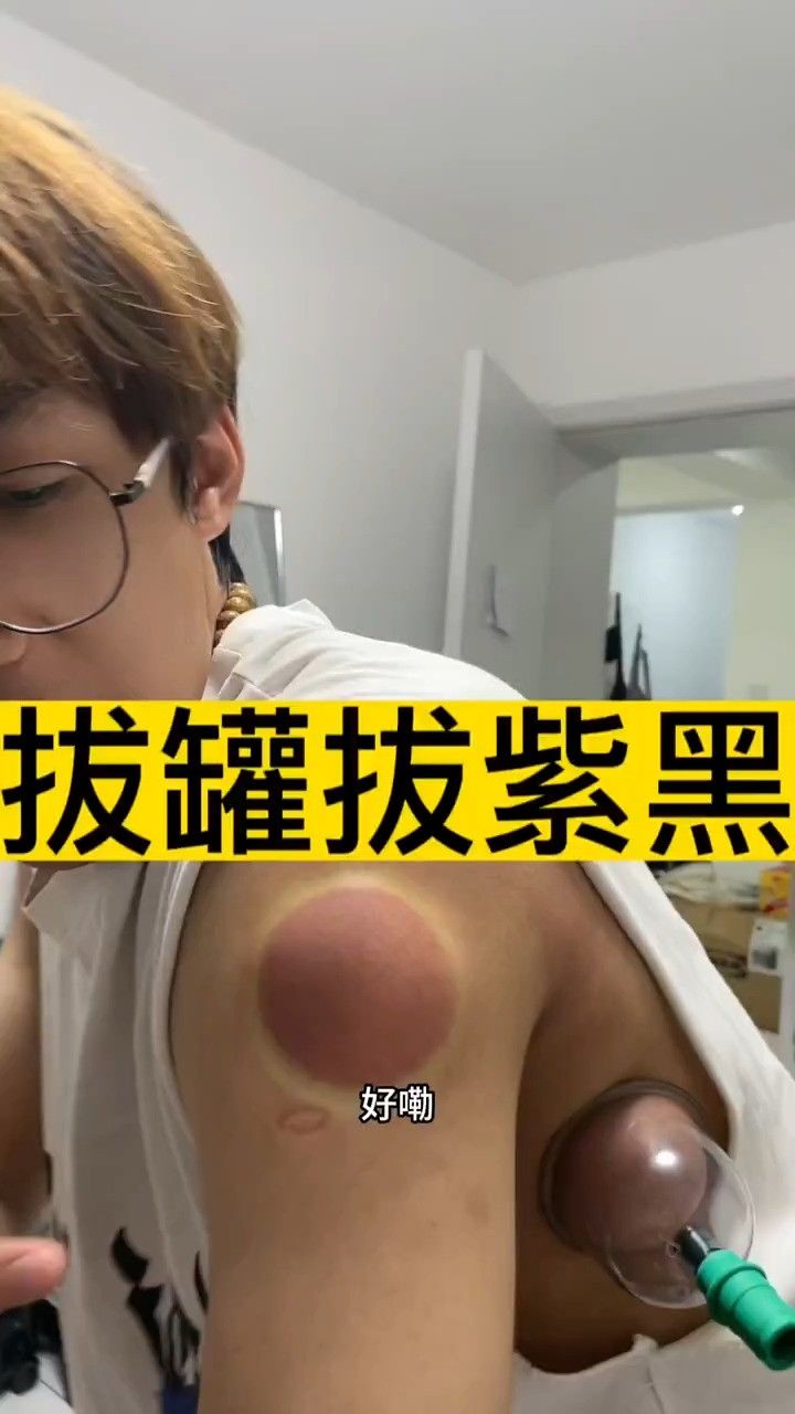 拔罐拔紫黑