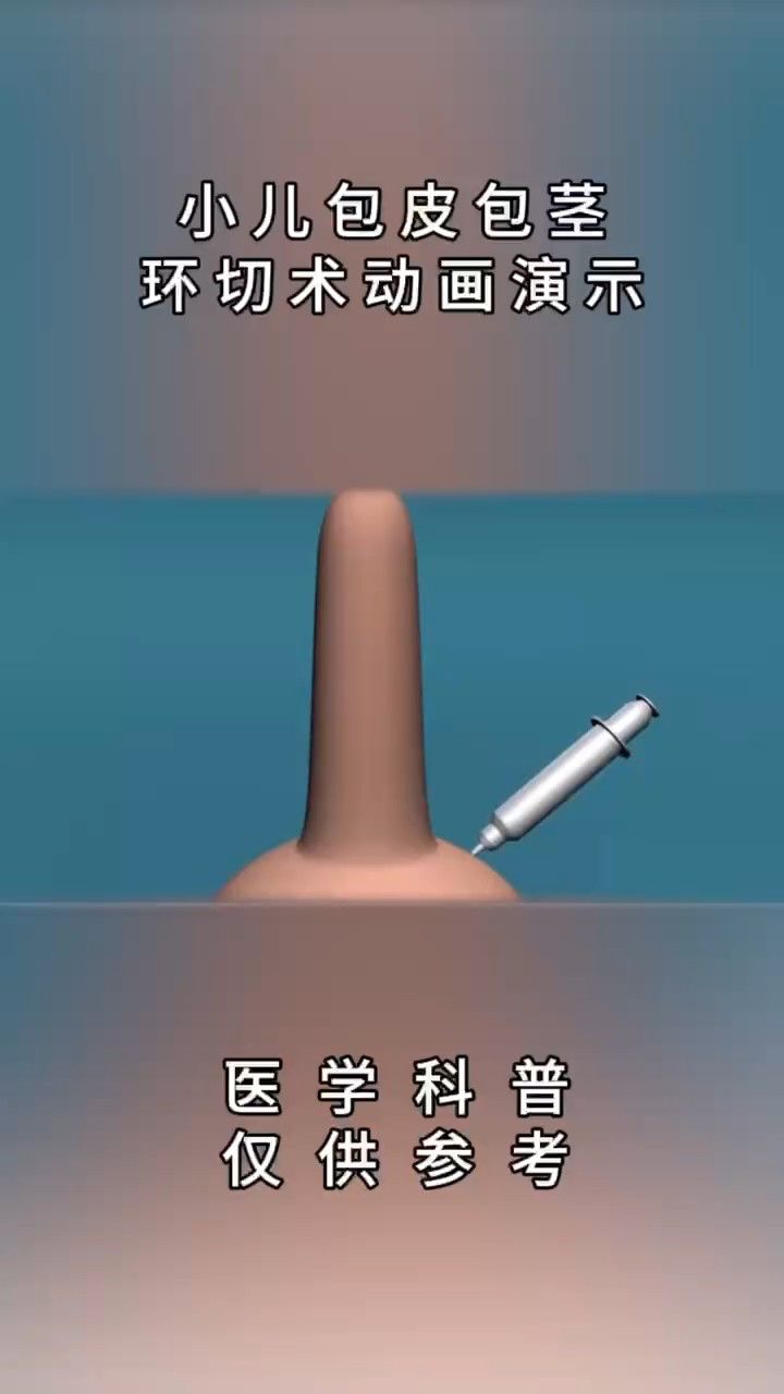 大连美琳达妇产-3d动画揭秘小儿包皮环切术真相
