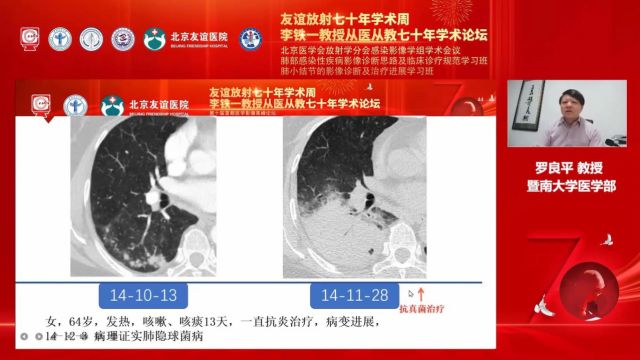 肺隐球菌病的CT诊断与鉴别诊断暨南大学医学部罗良平