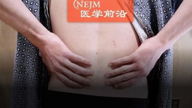 NEJM视频:关节突关节所致腰痛的治疗