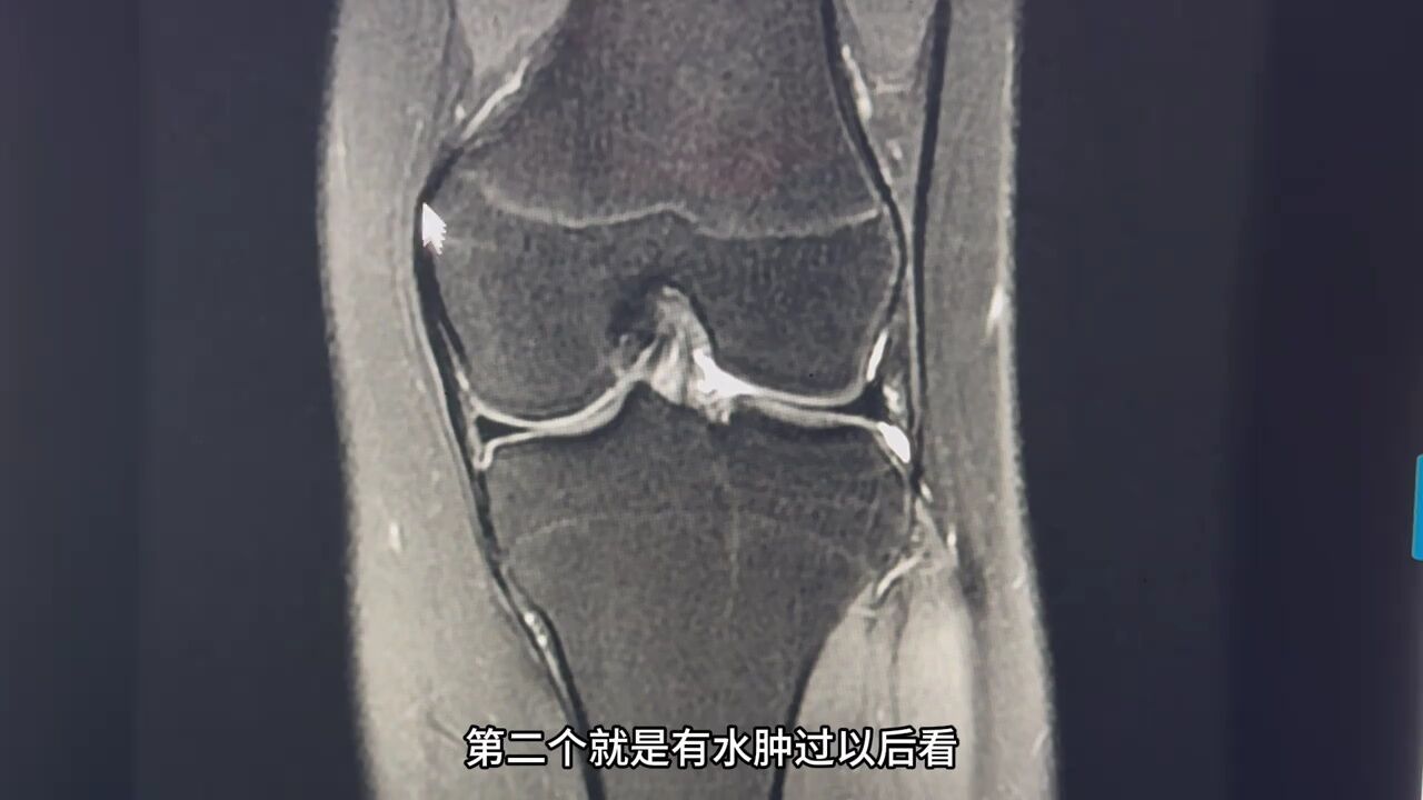 膝关节内侧副韧带解剖及损伤MRI诊断要点_高清1080P在线观看平台_腾讯视频