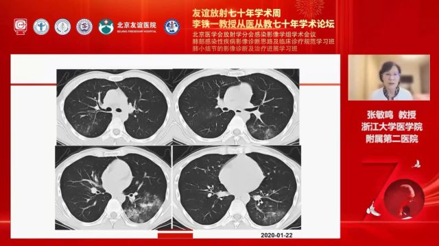 病毒性肺炎的CT鉴别诊断思路浙江大学医学院附属第二医院张敏鸣