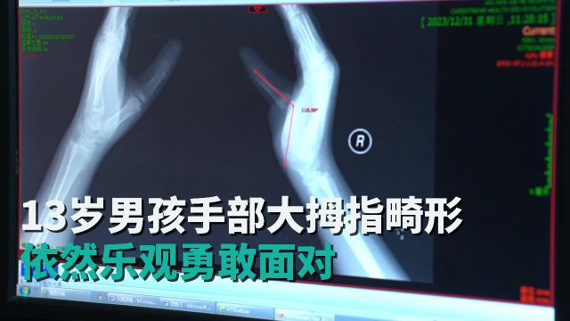 13岁男孩手部大拇指畸形依然乐观勇敢面对