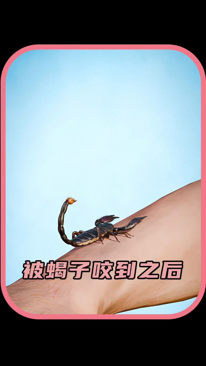 被蝎子咬了之后会怎样?