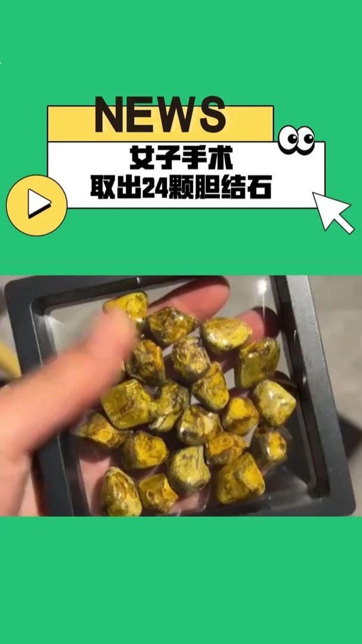 胆结石严重吗图片