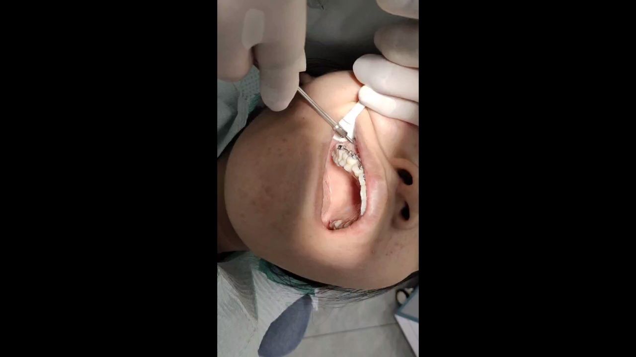 支抗钉植入视频2