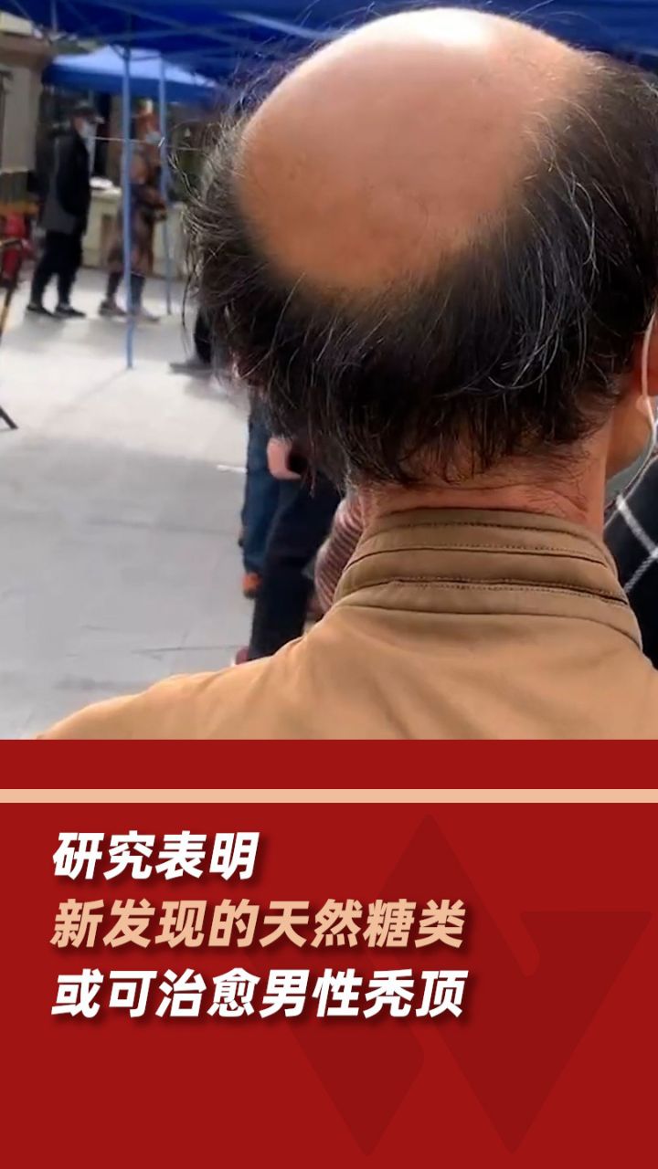 男人为何秃顶图片