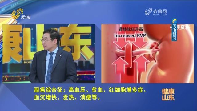 患了肾癌会出现代谢异常吗?专家:10%~40%患者会出现副癌综合征