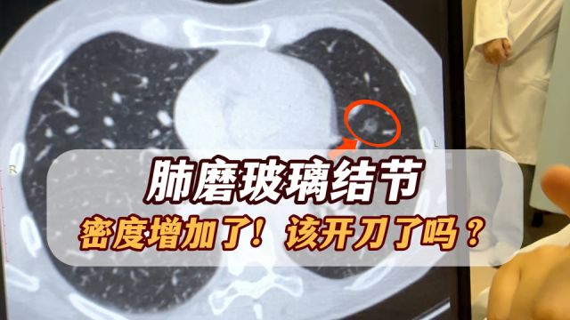 肺磨玻璃结节,复查“变白了”!该开刀了没有?