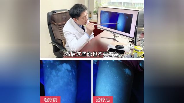 【病案实例】潍坊白癜风是怎么治疗腿部上的白斑的?