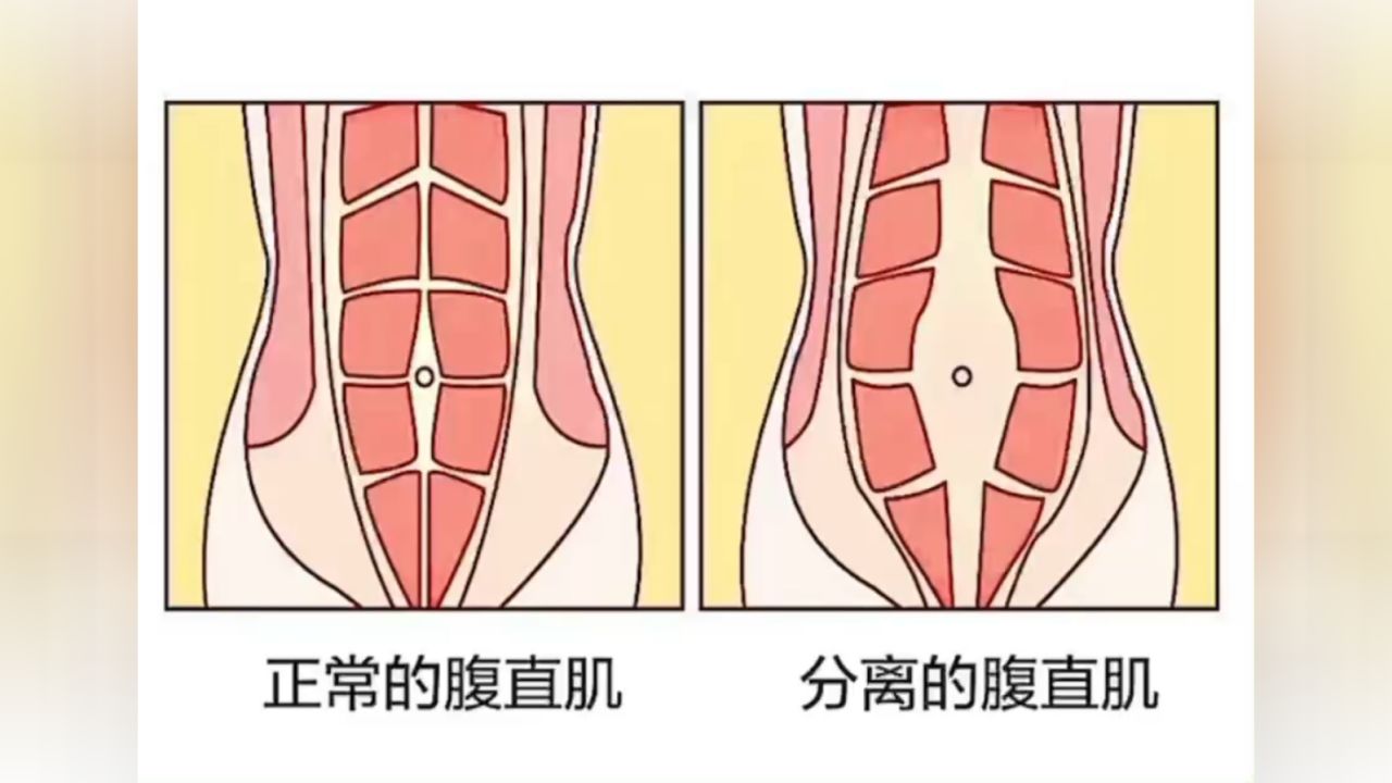 腹直肌分离,造成产后诸多问题!