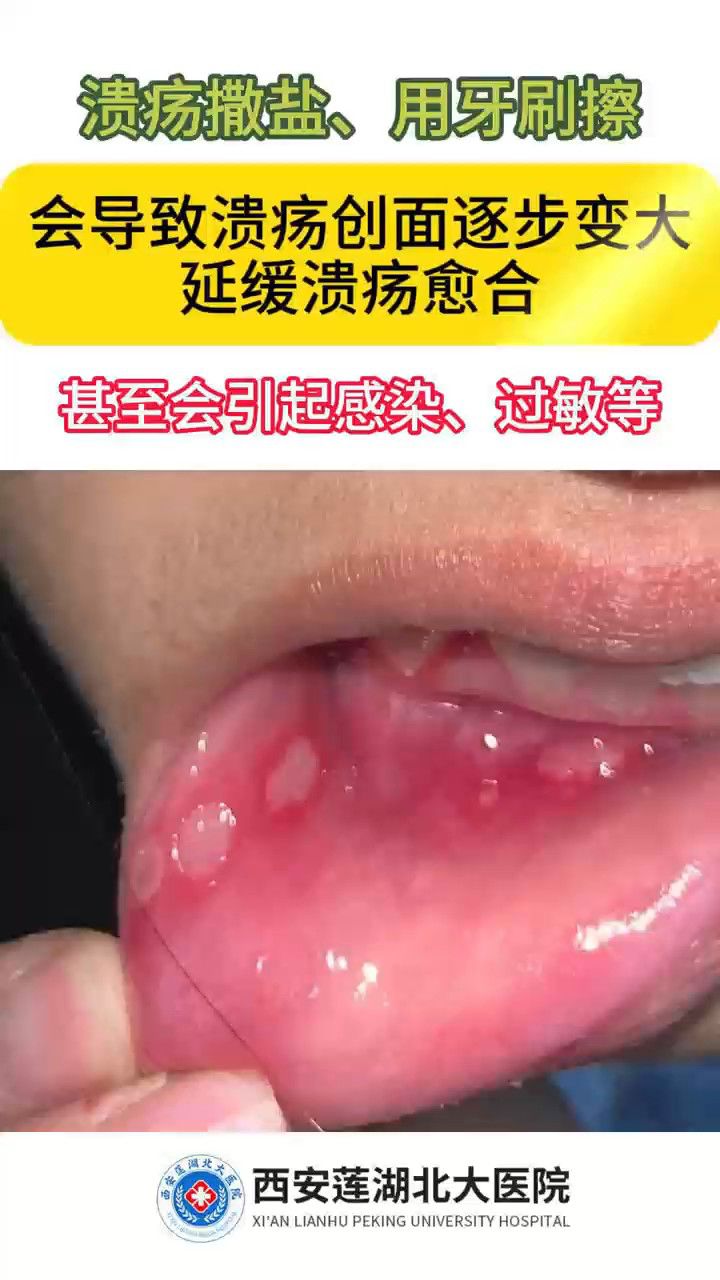 口腔溃疡形成图片